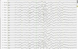 Hepatology：更便宜的EEG系统也能<font color="red">诊断</font>肝<font color="red">性</font>脑病