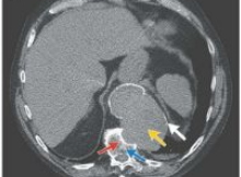 NEJM：胸主动脉瘤致椎体侵蚀-案例报道