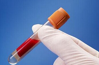 J ALZHEIMERS DIS：血液测试可用于检测慢性<font color="red">创伤性</font>脑<font color="red">病</font>