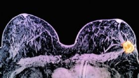 英医生发现应对乳腺癌速效药 2周癌细胞消失