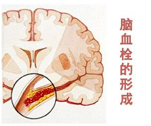 注意：老年脑血栓七大症状警示