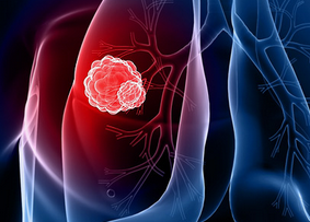 Clin Cancer Res：科学家鉴别出指示肺癌化疗法效果的新型标志物