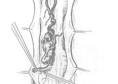脊髓血管畸形手术