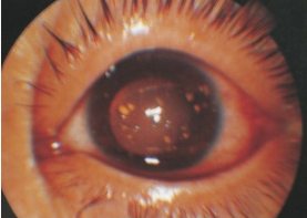 先天性瞳孔残膜、瞳孔膜闭，<font color="red">虹膜</font>前隆、马凡综合症、警惕半脱位混浊