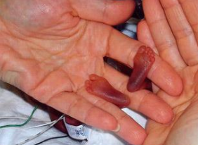 Obstet Gynecol：产前使用糖皮质<font color="red">激素</font>可降低<font color="red">妊娠</font>24周前出生新生儿的死亡率