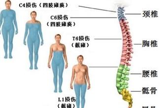 Spine：颈椎脊髓损伤的流行病学研究