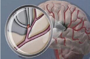 Stroke：动脉弯曲度是儿童卒中的影像学生物标志物