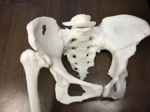 湘雅三医院：3D打印技术用于脊柱截骨手术