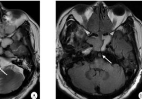 Int J Stroke：通过<font color="red">高分辨率</font>血管壁MRI发现颅内斑块增强预测卒中复发