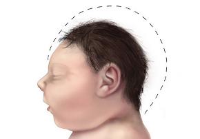NEJM：孕早期感染Zika病毒，该如何检查小头畸形？
