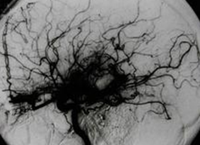 J Neurosurg：烟雾病功能学解剖和行为关联之间的初步研究