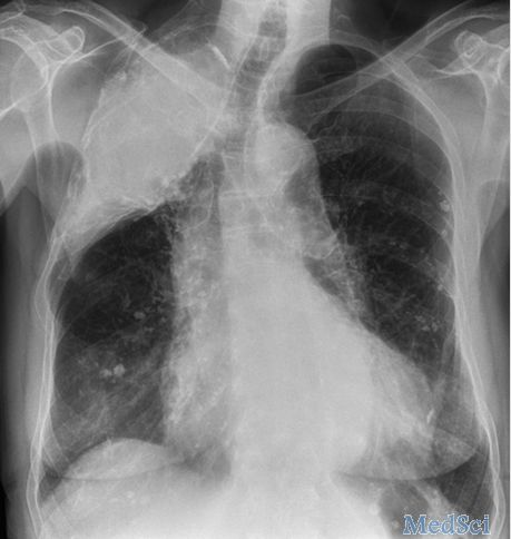 BMJ：一例疑似咳嗽和上呼吸道感染患者