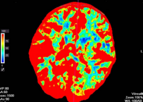 Eur J Radiol：使用脑血流量权重的动脉自旋标记MRI发现卒中后小脑失<font color="red">联络</font>