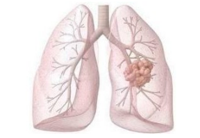KIT突变致ROS1阳性肺癌对克唑替尼耐药