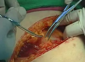 ASA 2015 知识更新（二十一）剖宫产手术麻醉的最新观点