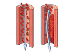 BMJ：血管内治疗  vs  单纯药物治疗缺血性卒中