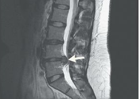 NEJM：一例腰椎间盘突出症保守治疗案例报道
