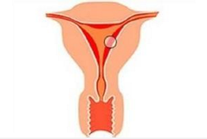 宫内节育器与生殖道感染的研究