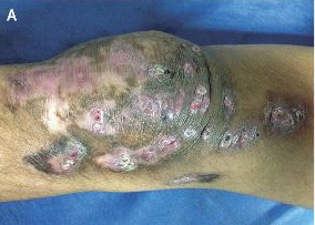 NEJM：皮肤放线菌病-案例报道