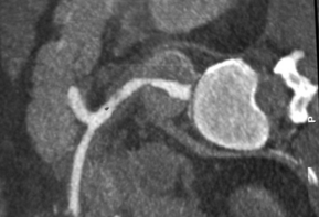 J Stroke Cerebrovasc Dis：灌注加权显像和弥散加权显像100%不匹配急性A型主动脉夹层