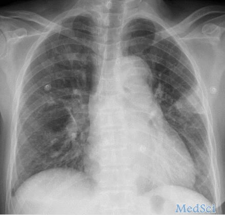 BMJ：肺栓塞驼峰征-案例报道