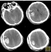 Lancet Neurol：<font color="red">扫描</font>昏迷大脑或可预测患者能否恢复意识
