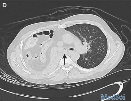 NEJM：<font color="red">Morgagni</font><font color="red">疝</font>致肺塌陷-案例报道