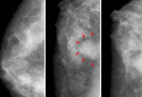 JAMA：乳房钼靶摄像二次读片<font color="red">顺序</font>对乳腺癌检出率有影响吗？