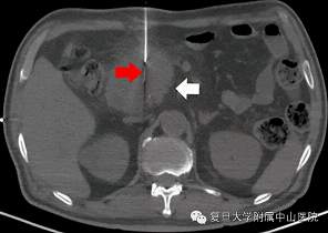 【全球首例】中山医院成功完成“CT导引下胰腺射频消融导管治疗胰腺癌”