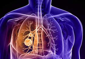 张新教授：非小细胞肺癌免疫治疗研究进展