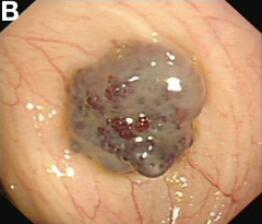 Gastroenterology：蓝色橡皮疱痣综合征（BRBNS）-华西医院案例报道