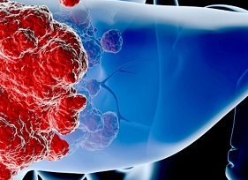 ACS Nano：借助纳米颗粒可实现肝癌细胞<font color="red">成像</font>