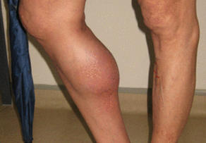 BMJ：小腿突发疼痛，红斑和肿胀——病例报道