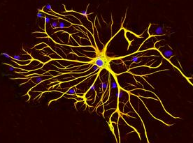 Neurology：科学家发现与常见致死脑瘤相关的免疫基因