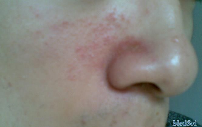 脸上的红疹子可能是脂溢性皮炎