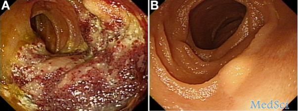 Gastroenterology：小肠淋巴管瘤-案例报道