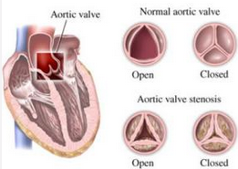 JACC：<font color="red">自</font><font color="red">扩张</font>经导管主动脉瓣置换（<font color="red">TAVR</font>）可显著改善患者2年时生存率