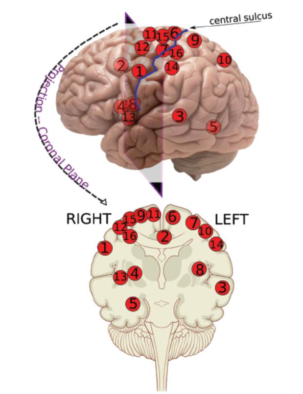 J Neurosurg：如何处理高级别<font color="red">脑</font>动静脉<font color="red">畸形</font>？