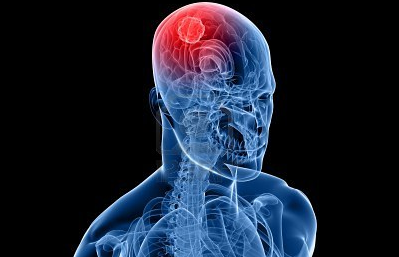 ASCO 2016：放疗后进行化疗或可有效改善罕见脑瘤患者的生存率
