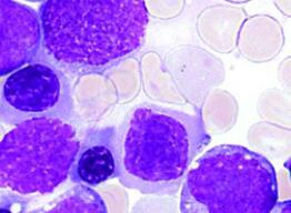 Nature：靶向攻击<font color="red">p</font>53和c-MYC可选择性清除白血病干细胞