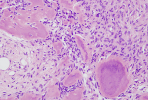 Lancet：olaratumab联合阿霉素可显著改善晚期或转移性软组织肉瘤患者的无进展生存期