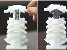 世界首个3D打印人工脊椎植入成功
