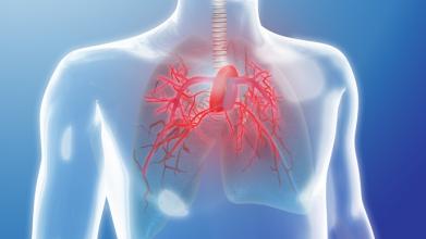 Lancet Respir Med：利奥西呱治疗慢性血栓栓塞性肺动脉高压的安全性耐受性研究