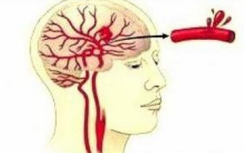 Lancet Neurol：急性缺血性卒中可早期应用<font color="red">阿</font>替<font color="red">普</font>酶治疗