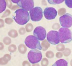 Leukemia：中国科研人员发现治疗白血病<font color="red">新型</font><font color="red">抑制剂</font>