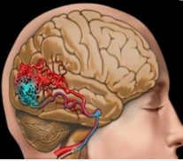 J Neurol Neurosurg Psychiatry:  脑出血患者，早期强化降压治疗可减少抗<font color="red">栓</font>治疗所致血肿增加
