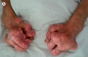 Lancet：手部巨大痛风结石案例报道