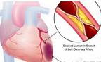 <font color="red">Atherosclerosis</font>：HDL3-C对心血管疾病存在保护作用