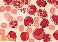 Cancer：<font color="red">AML</font>患者自体<font color="red">干细胞</font>移植后仍面临着疾病复发的风险