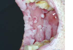 NEJM：艾滋病患者HPV相关的口腔乳头瘤样增生-病例报道